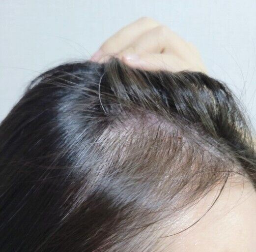 SOME BY MI Cica Peptide Anti Hair Loss Derma Scalp Treatment 50ml/1.69 fl.oz.